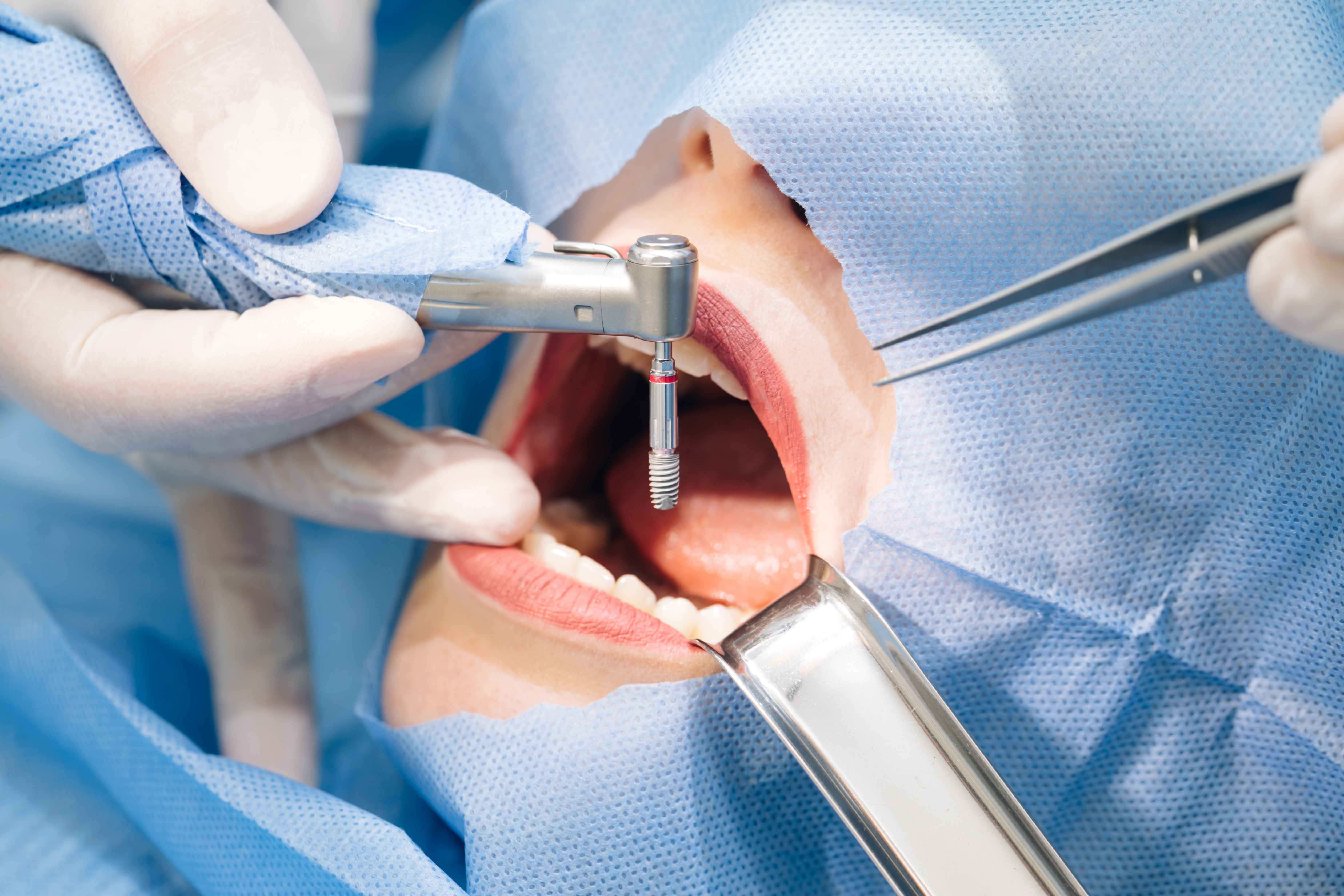 What is Oral Surgery? A Comprehensive Guide to Oral & Maxillofacial Procedures