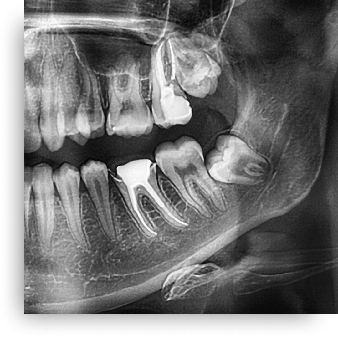 wisdom teeth x-ray