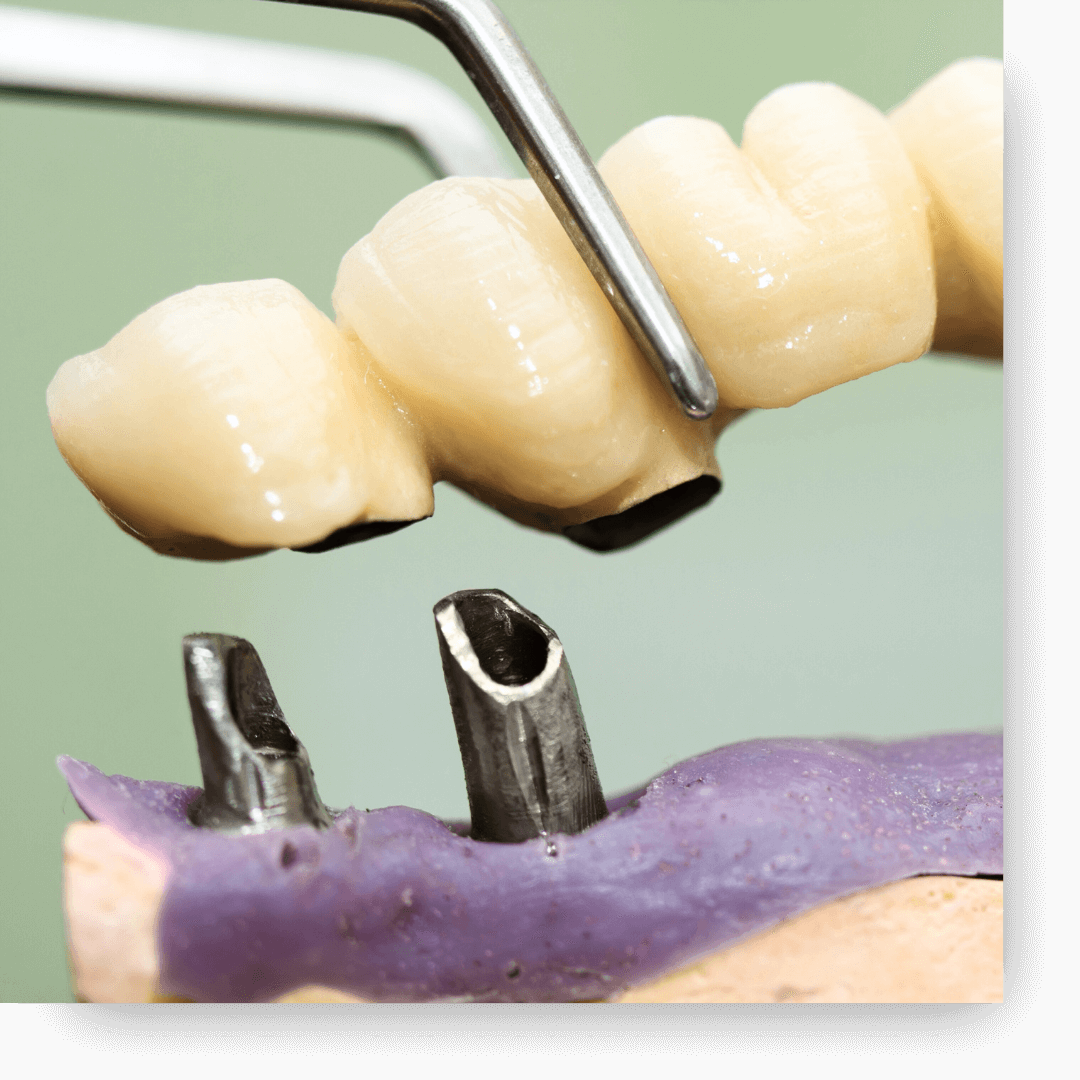 Close-up of a ceramic dental bridge being lowered by metal forceps onto two titanium implant abutments on a purple dental model.